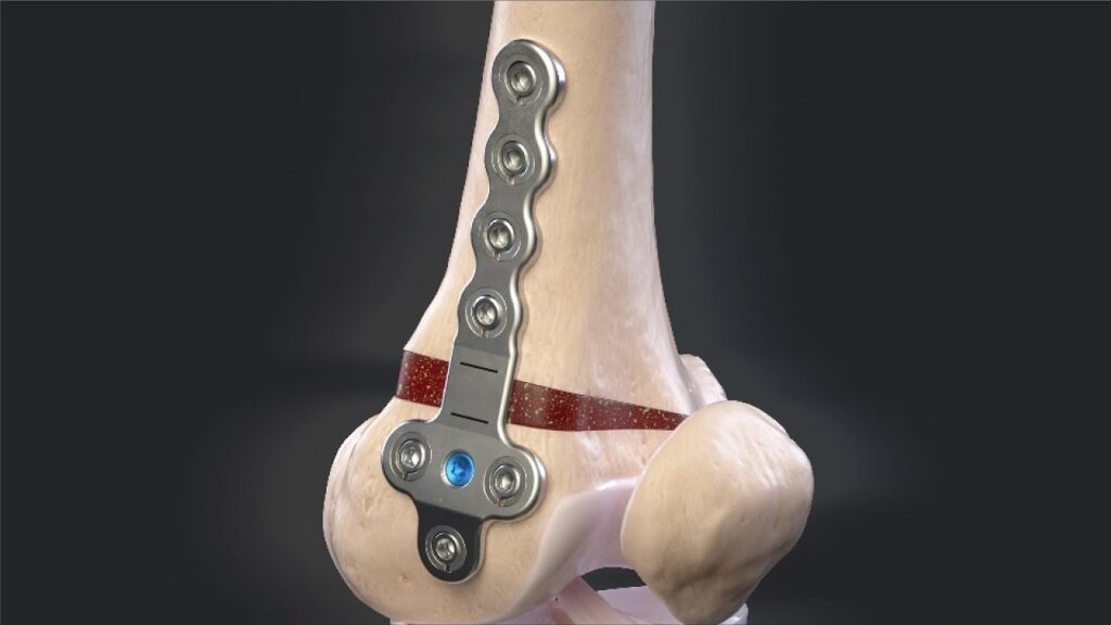 Distal Femur Osteotomy DFO Surgery In Rewa Dr Dinesh Kumar