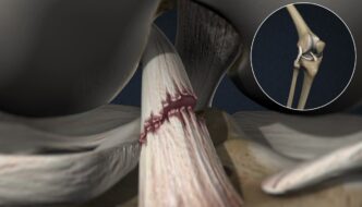 Anterior Cruciate Ligament