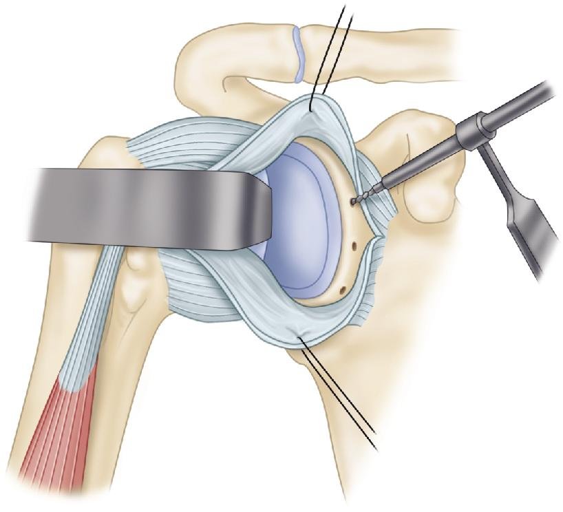 Bankart Repair - Dr. Abhinav Singhal