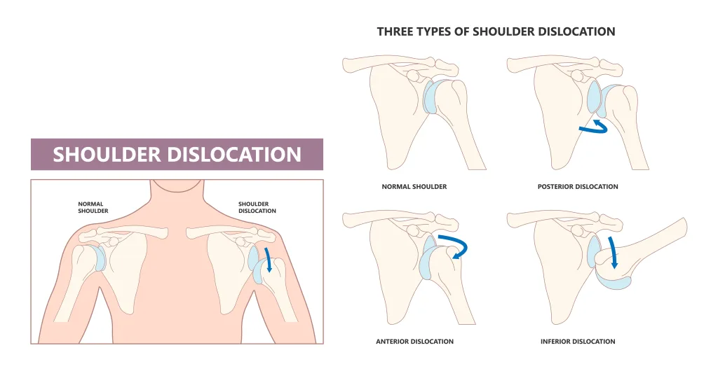 Recurrent Shoulder Dislocation