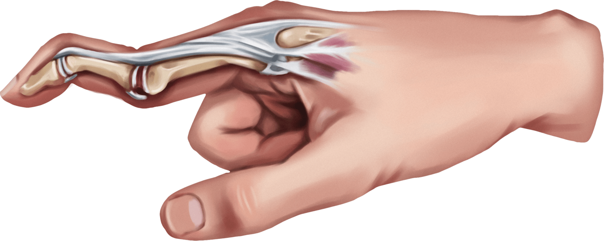 Swan Neck Deformity